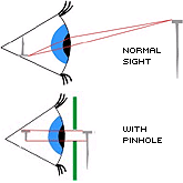 Normal Sight: Normal ray tracing of light to the retina. Shows image will 